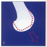 Total Knee Arthroplasty - Step 1