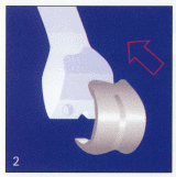 Total Knee Arthroplasty - Step 2
