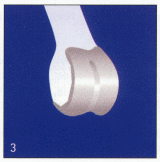 Total Knee Arthroplasty - Step 3