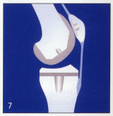 Total Knee Arthroplasty - Step 7