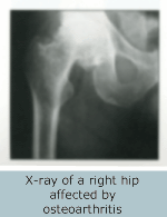 Hip x-ray