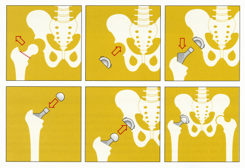 Hip surgery