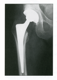 Hip x-ray