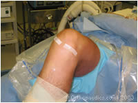 The sterile strips used to close the minimal wounds