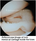 Torn meniscal cartilage