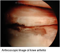 Image of Arthritis