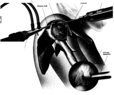 The position of the arthroscope and electronic shaver for busal arthroscopy and subacromial decompression